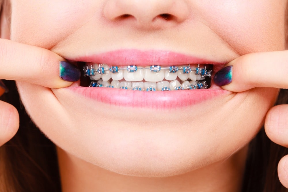 Crescent Orthodontics in Palm Beach Gardens explain what each part of the traditional braces does for you and your teeth