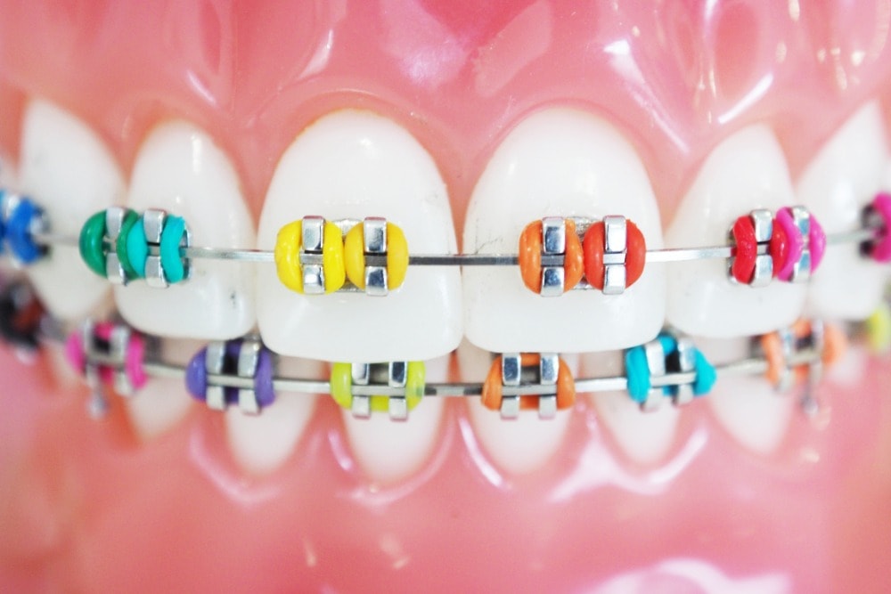Colourful brackets and rubberbands with WildSmiles